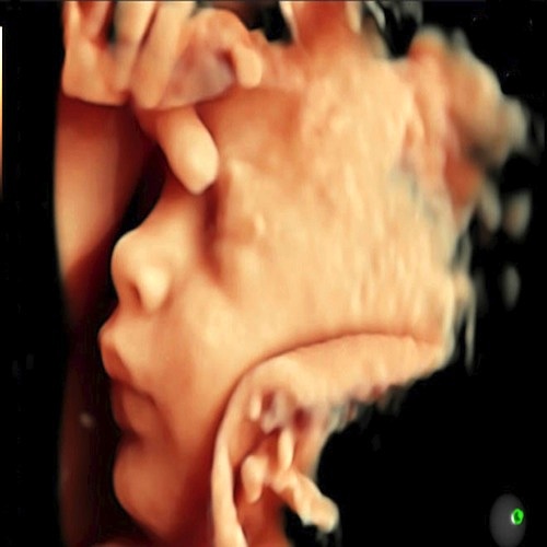 3D ultrasound of a baby